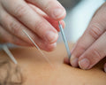 Medical Acupuncture in Congleton